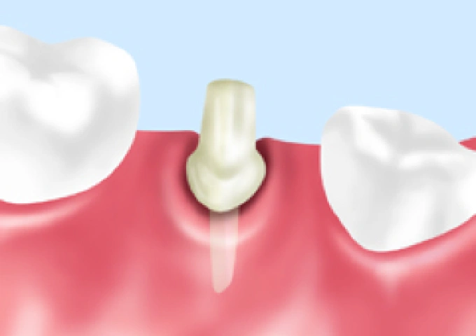 ファイバーコア