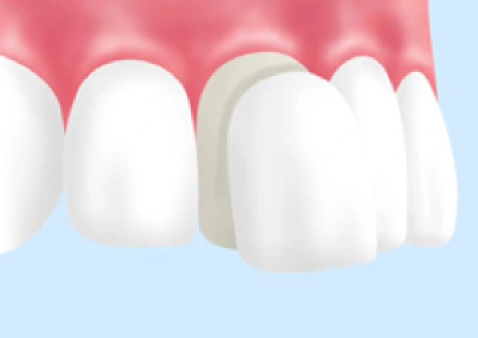 ラミネートベニア