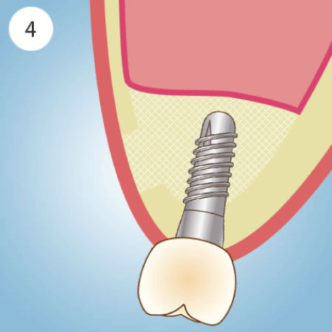 サイナスリフト治療の流れ 4
