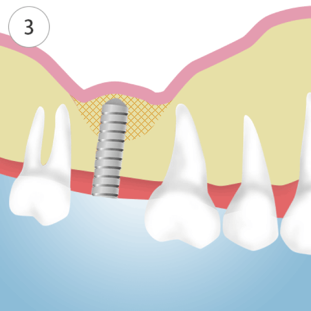 ソケットリフト治療の流れ 3