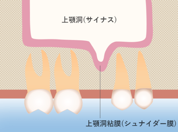 ソケットリフト