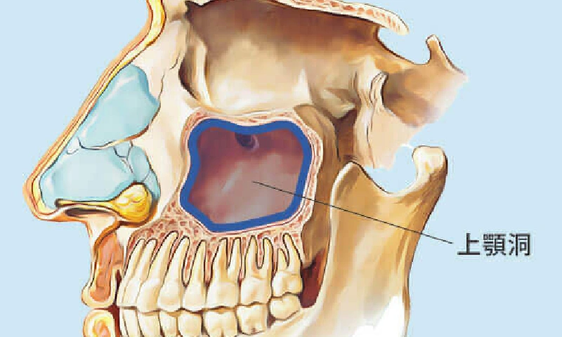ソケットリフト・サイナスリフト