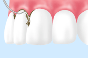 [画像]歯周病治療