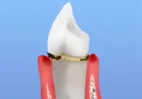 [画像]初期歯周炎