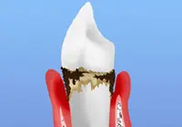 [画像]後期歯周炎