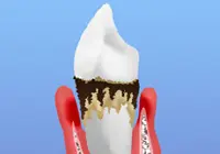 [画像]末期歯周炎