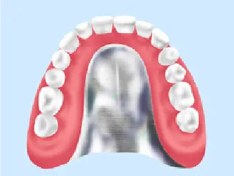 [写真]金属床の総義歯